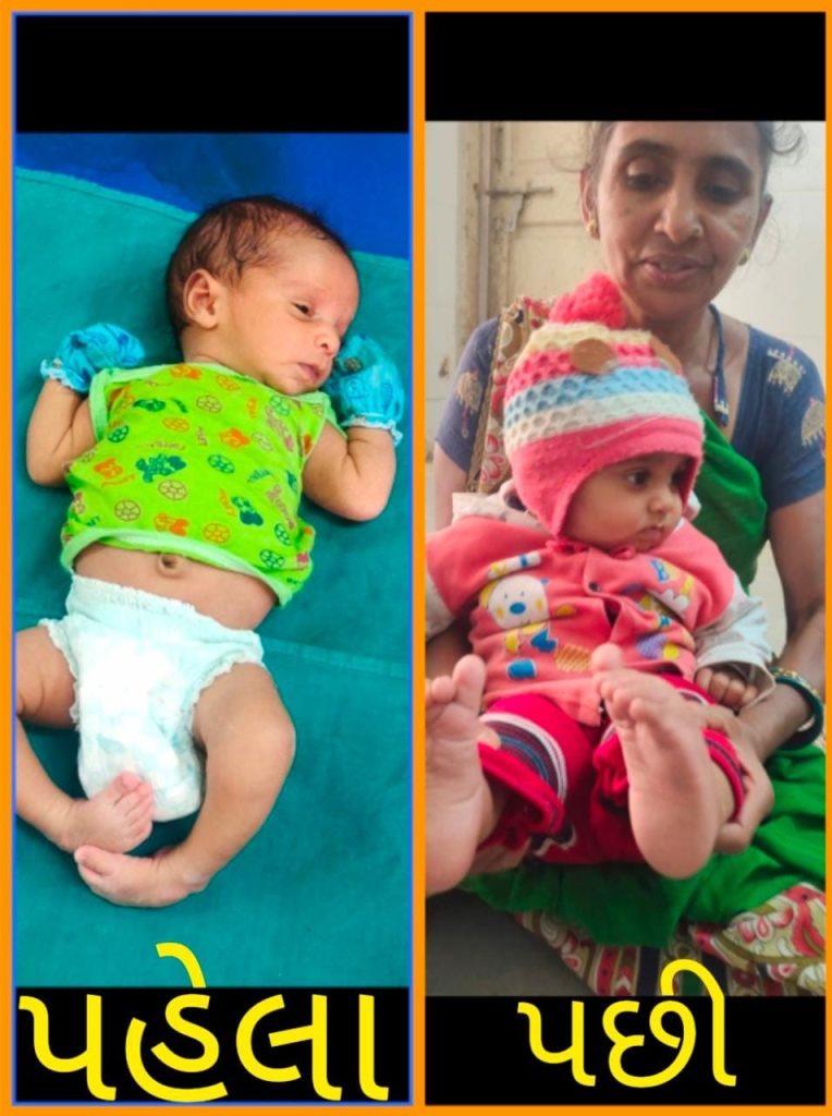 Free Treatment of Clubfoot - સુરેન્દ્રનગર મહાત્માગાંધી હોસ્પિટલમાં RBSK & અનુષ્કા ફાઉન્ડેશન ફોર ઈલીમીનેટીંગ ક્લબફૂટ દ્વારા ક્લબફૂટની મફતમાં સારવાર
